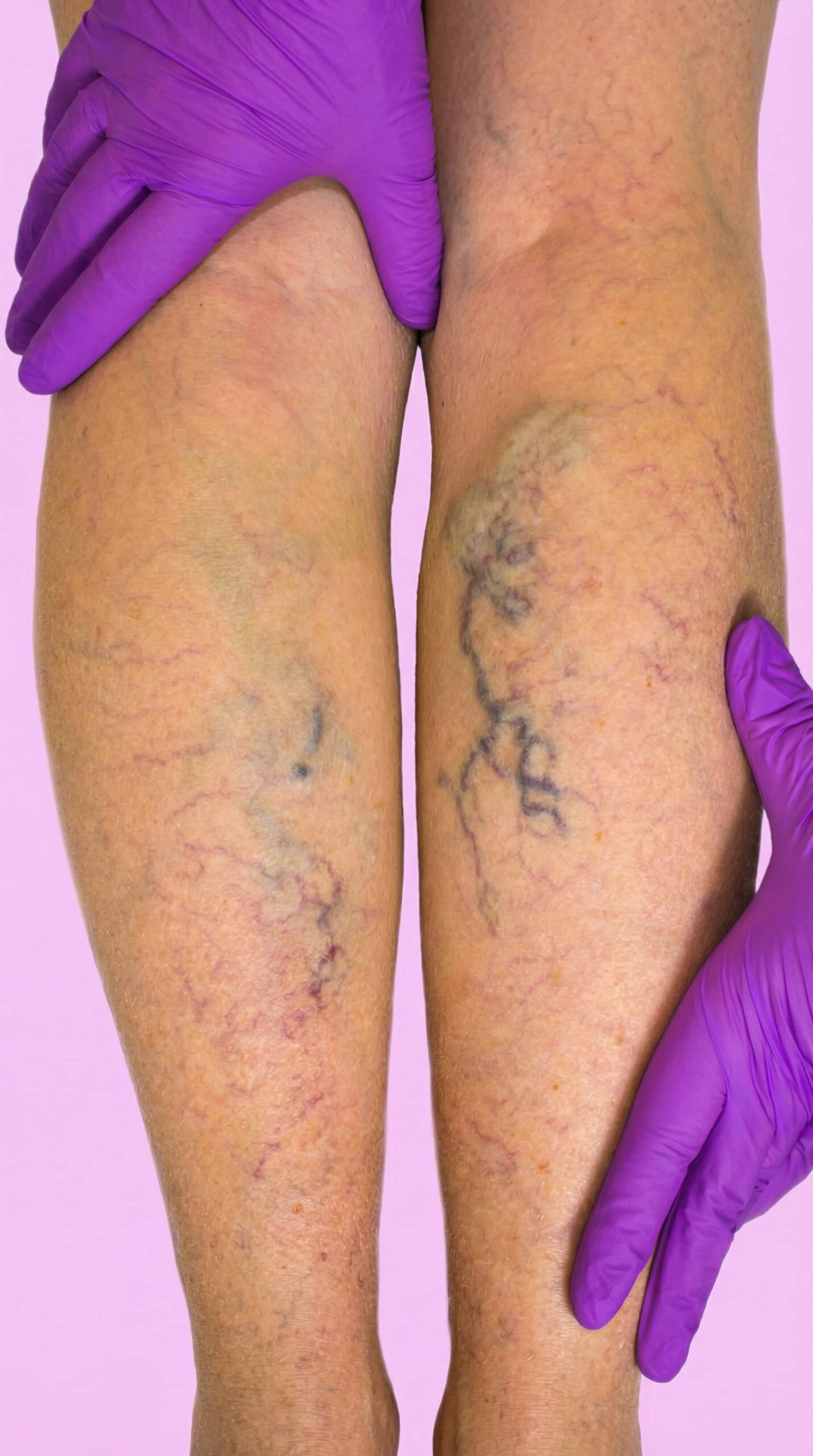 Piernas antes del protocolo - con várices